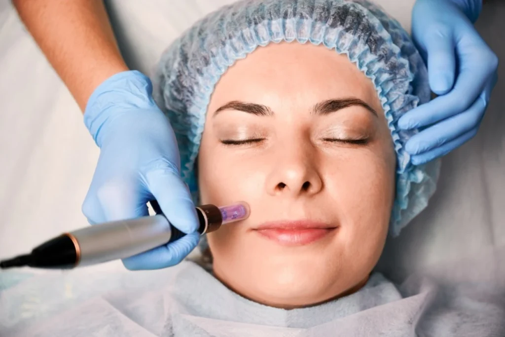 microneedling-facial-treatment-aesthetics