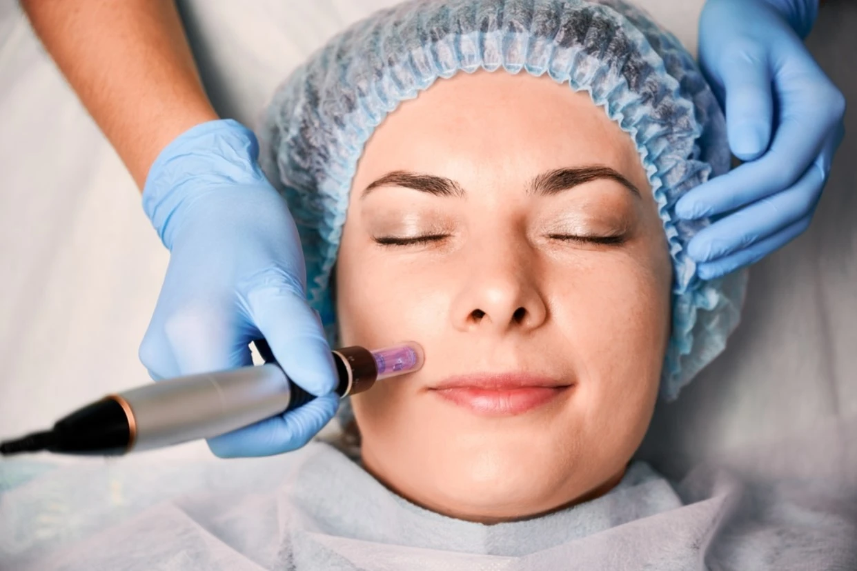 microneedling-facial-treatment-aesthetics