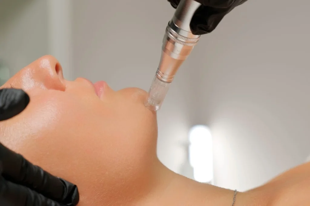microneedling-facial-treatments